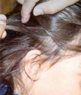 Non-Toxic and Natural Head Lice Treatment